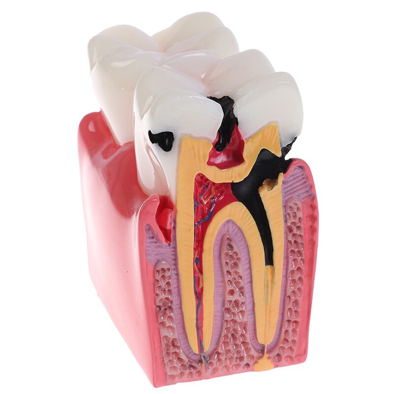 Dental Teeth Model 6 Times Caries Comparation Study Denture Tooth Models