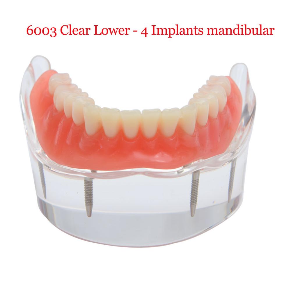 Dental Implant Teeth Teaching Model Overdenture Restoration Clear Removable Interior Maxillary Mandibular Tooth Demonstration: 6003 Lower  4