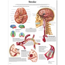 Anatomie van Hersenen in Slag Anatomische Grafiek Neurologische Posters Pathologie Canvas Muur Foto 'S voor Medische Onderwijs Home Decor