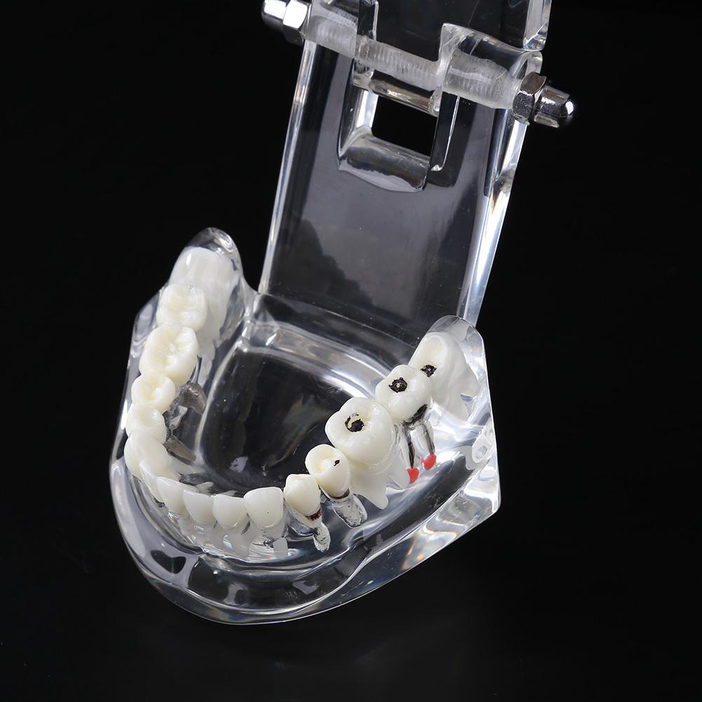 Dental Implant Ziekte Tanden Model Met Restauratie Brug Tand Tandarts Voor Medische Wetenschap Tandheelkundige Ziekte Onderwijs Studie