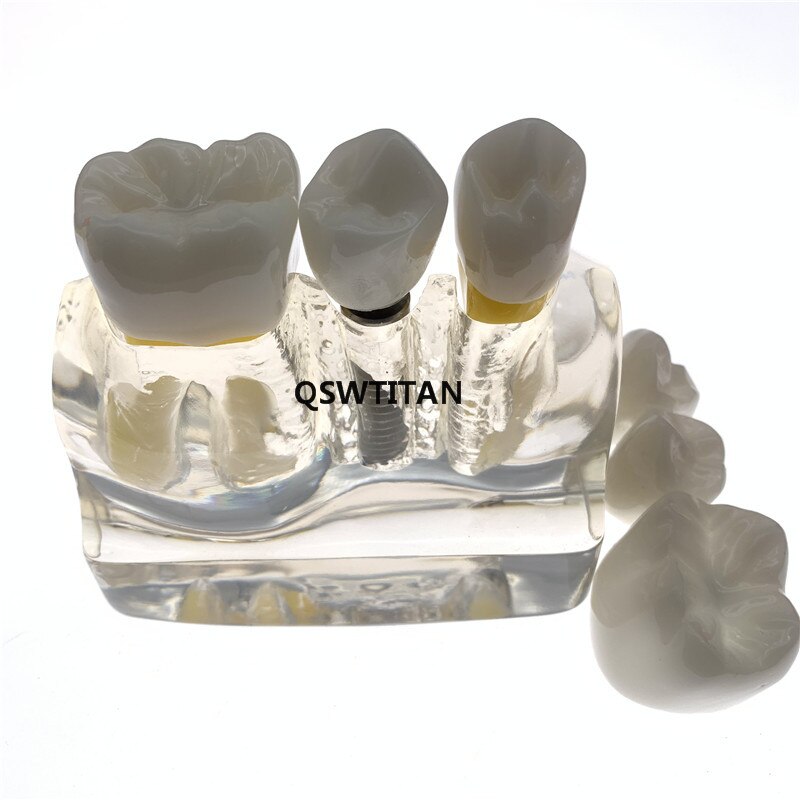 Clear Dental Demonstration Study Teeth Model for Implant Analysis Crown Bridge Model