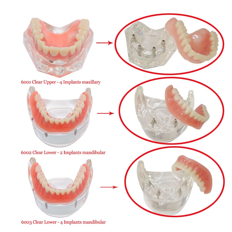 Dental Implant Teeth Teaching Model Overdenture Restoration Clear Removable Interior Maxillary Mandibular Tooth Demonstration