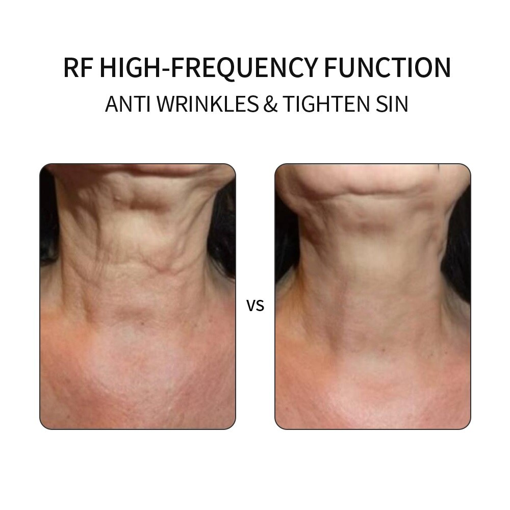 5in1 RF &Ampere; ems Radio Mesotherapie Elektroporation Gesicht Schönheit Stift Radio Frequenz LED Photon Gesicht Haut Verjüngung Entferner Falten