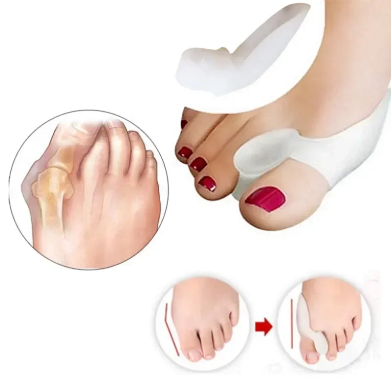 2 Stuks Siliconen Gel Duim Corrector Bunion Voet Teen Hallux Valgus Protector Separator Vinger Stijltang Richter Voetverzorging Tool