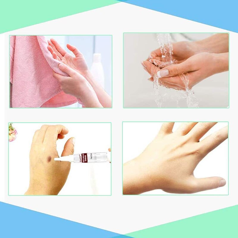 Veeg Tags Mollen Remover 3Ml Skin Tags Mol Remover Effectieve Formule Voor Skin Tags Removal