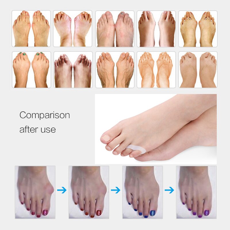 1-10 par novo toe separador interdigital corrector silicone guarda pé ferramentas de cuidados com o dedo alisador bunion pedicure ortopédico