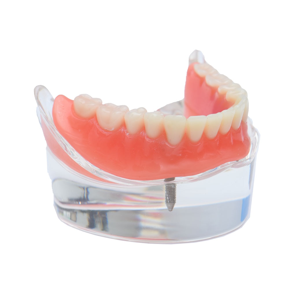 Dental Implant Teeth Teaching Model Overdenture Restoration Clear Removable Interior Maxillary Mandibular Tooth Demonstration