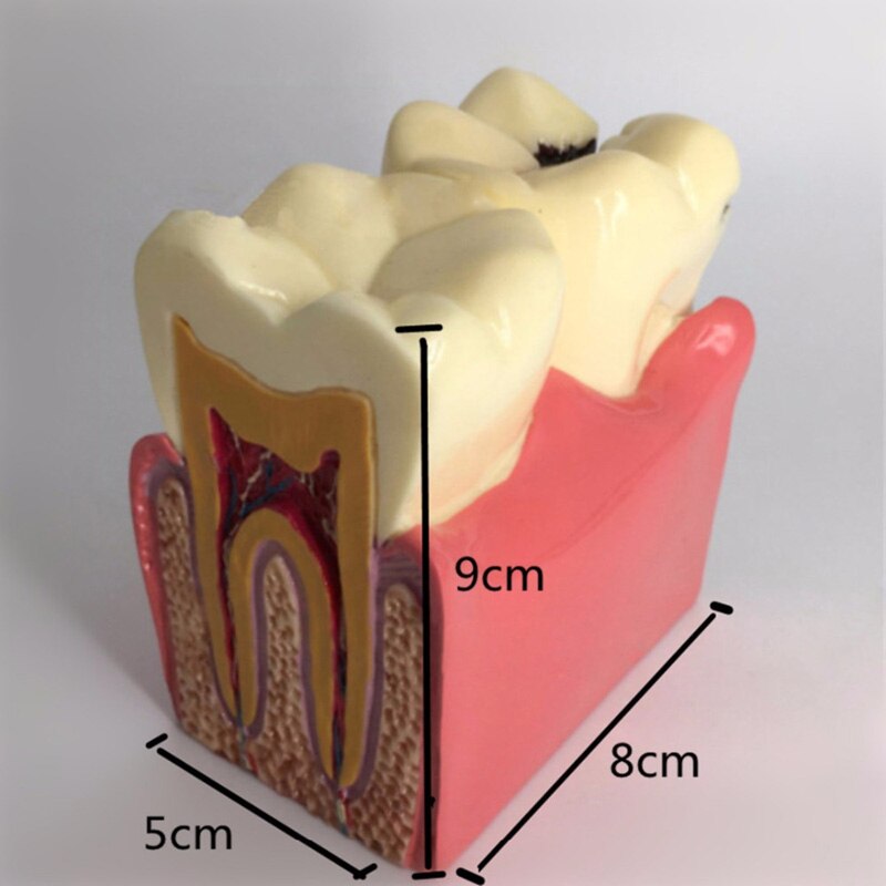 Dental Teeth Model 6 Times Caries Comparation Study Denture Tooth Models: Default Title