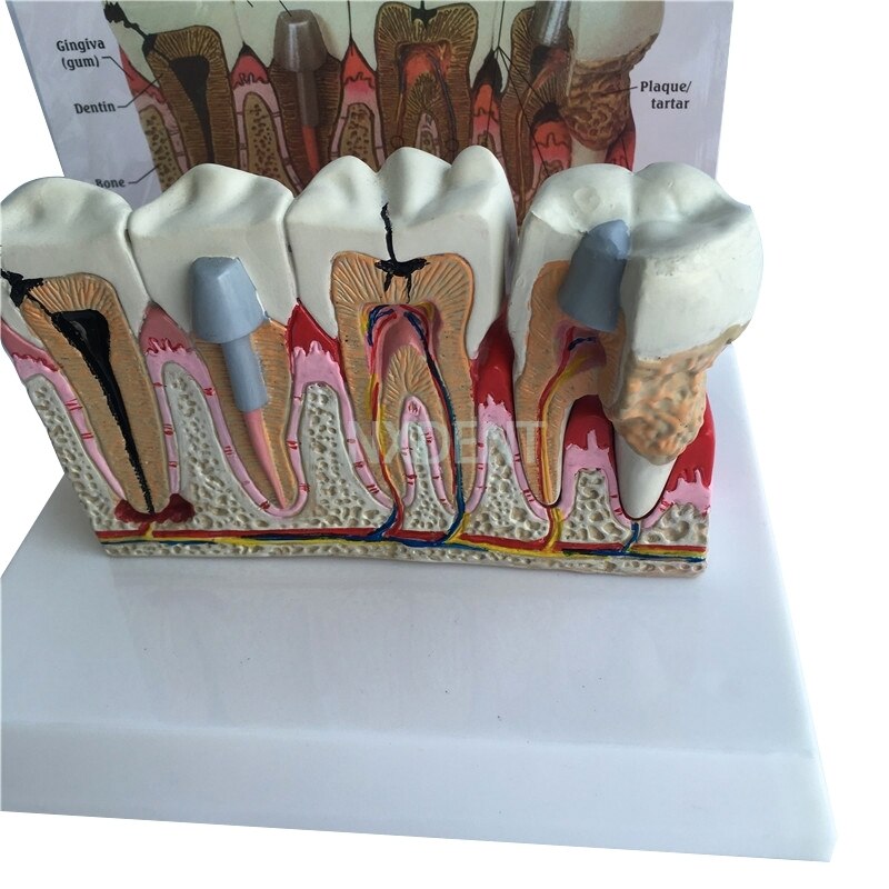 1 Stuks Dental Anatomische Tand Tanden Model Anatomie Tanden Model Oversized Anatomie Rotte Tand Demonstratie Communicatie
