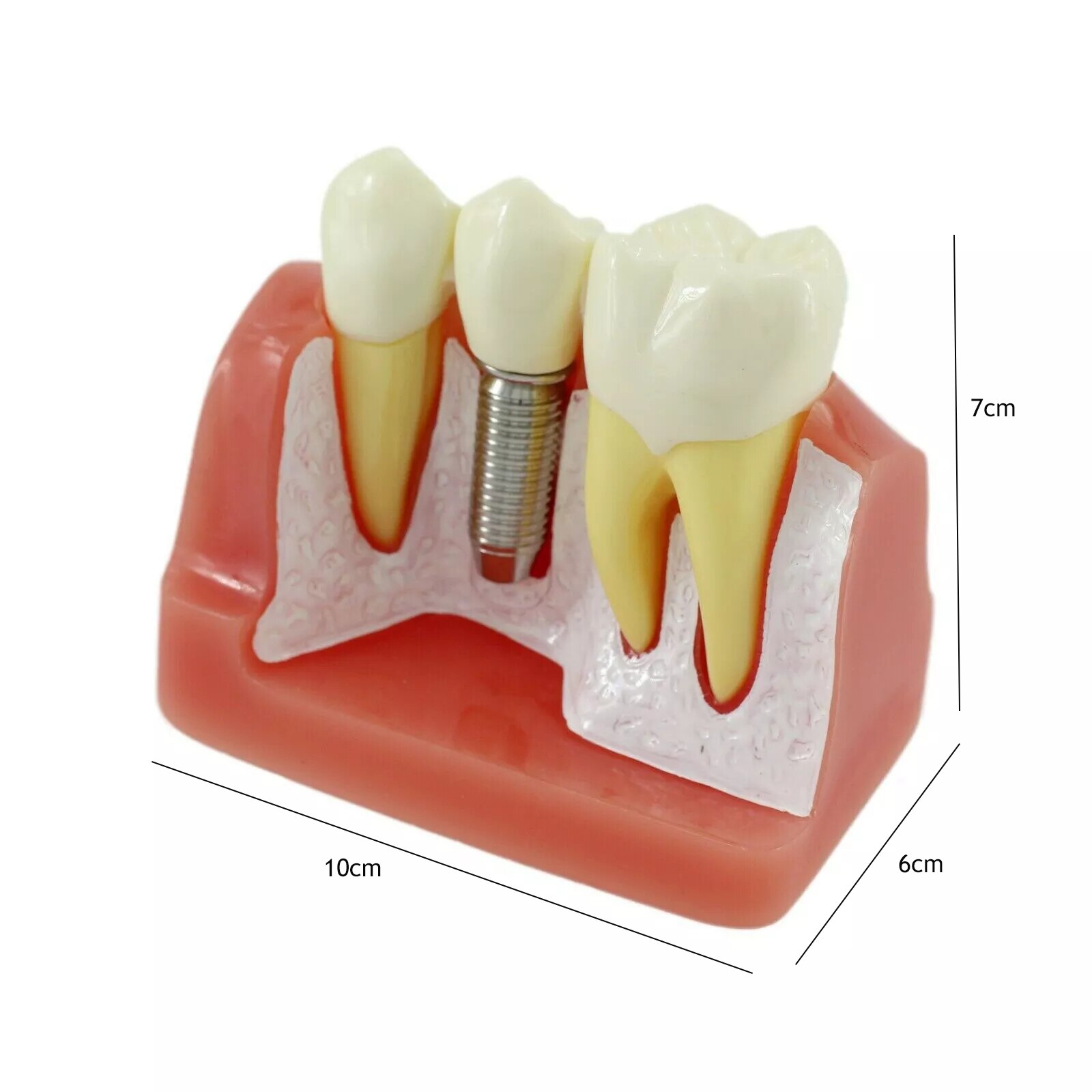 1Pcs Dental Tooth Implant Removable Model Crown Abutment Dentistry Laboratory Educational Materials Dentist Study Dentures M2017