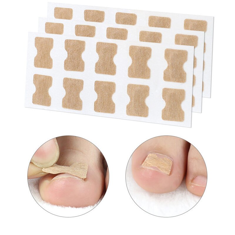 10/30/50/60Pieces Ingrown Toenail Correction Sticker Nail Ingrowing