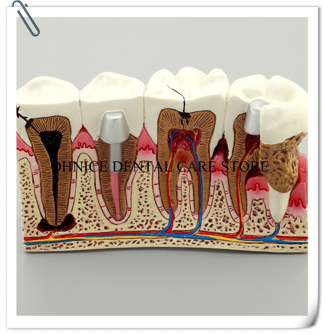 Dental Pathologies Model M4029 showing caries and apical lesion conditions/Dental Study tooth model Doctor-patient communication
