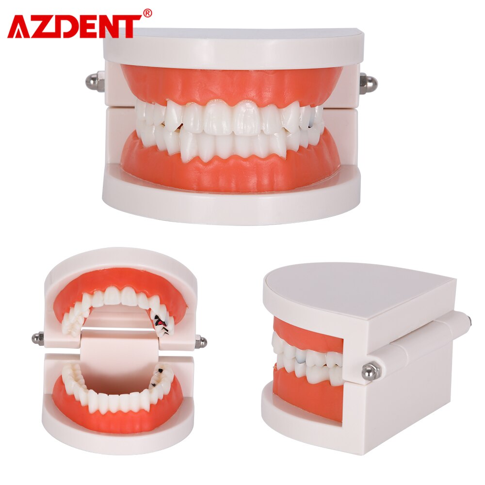 Dental Teeth Model Tooth Decay Model PVC School Teaching Equipment