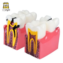 6 Times Dental Model Molar Pathological Anatomic Comparison Model To Facilitate The Study Of Tooth Structure And Lesion Process