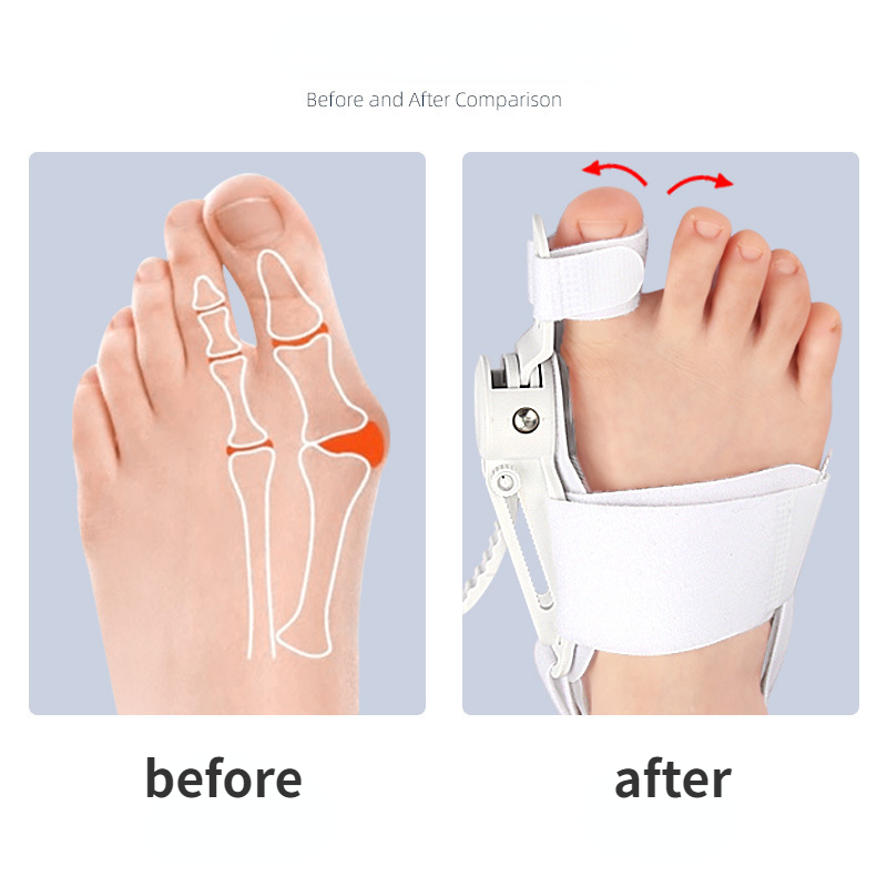 Hallux Valgus Corrector Ballenzehen für Zehen Corrector Fuß Finger Separator Zehenspreizer Fußpflege Bunion Corrector
