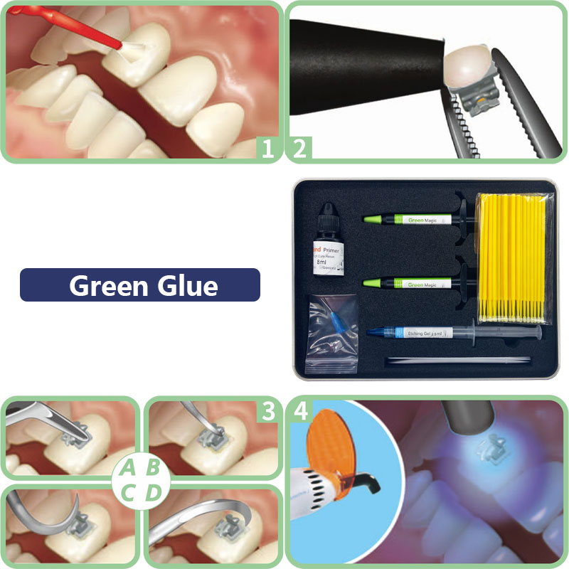 Adhesivo de ortodoncia Dental, Kit de pegamento de curado automático/ligero para soportes de ortodoncia, pegamento azul, sistema de unión directa de odontología