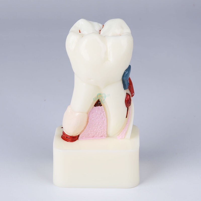1 pièces dentiste étude dentaire enseignement modèle de dent 4 modèles de maladie des dents