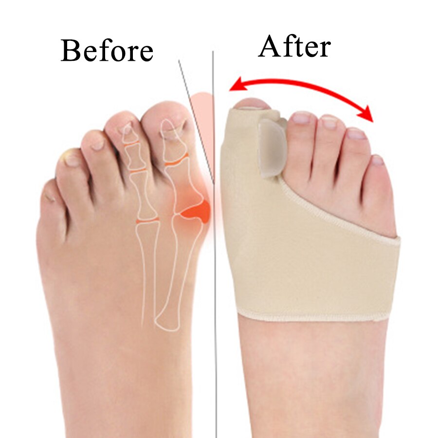 Corrector ortopédico de juanete, calcetines de silicona para pedicura, Corrector de Hallux Valgus, para el cuidado de los pies, separadores de dedos, plantilla ortopédica