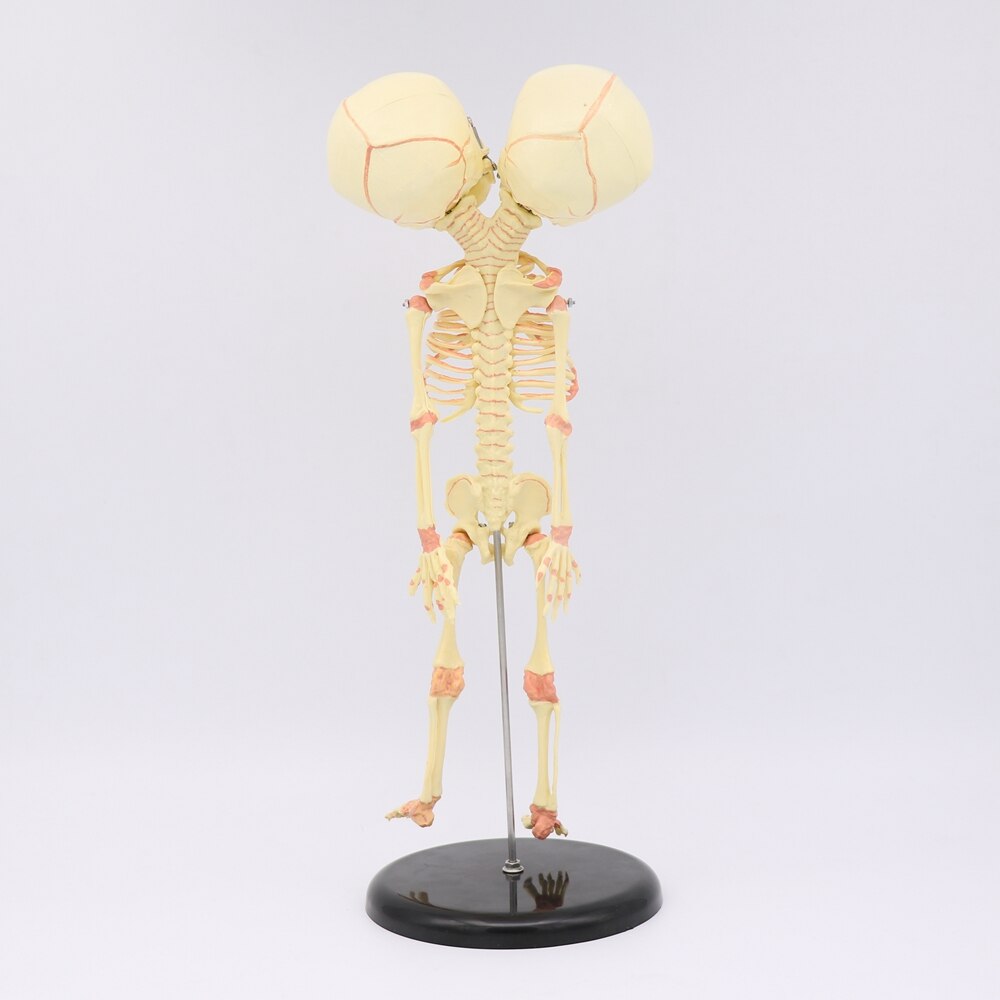 35CM crâne à deux têtes humain -né bébé Double tête anatomie crâne squelette anatomique éducation cérébrale modèle d'étude anatomique