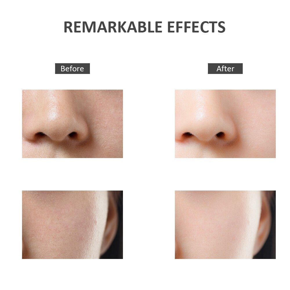 Heating Skin Scrubber Vibrating Facial Deep Cleansing Electric Peeling Shovel Acne Pore Cleaner Face Lifting Skin Care Device