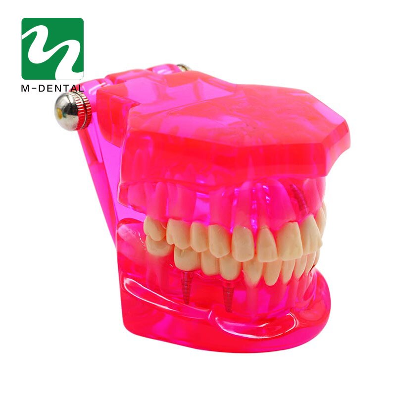 Modelo de dientes de estudio Dental desmontable para adultos, modelo de dientes de enseñanza patológica, rojo transparente, 1 unidad