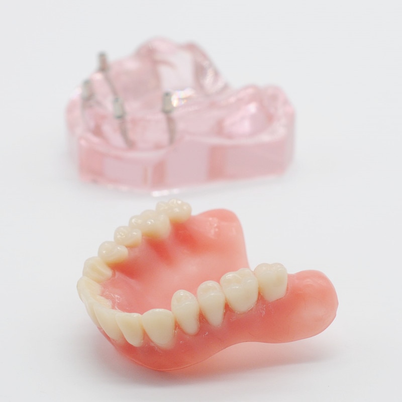Zahn Zähne Modell Overdenture Oberen Vorderseite Oberkieferzähne 4 Implantate Restaurierung Zahnarzt Artikel Zahnersatz Zahn Extraktion