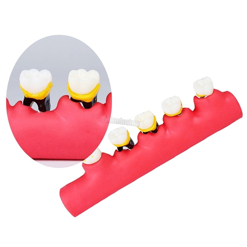 Dental Periodontal Disease Classification Model Demonstration Teach Study Decayed tooth Show Periodontal Disease Progress Model