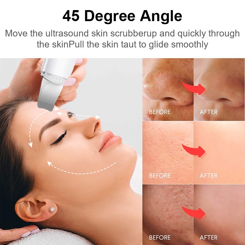 Xiaomi Mijia Ultrasone Huid Scrubber Trillingen Gezicht Spatel Comedondrukker Schop Schoon Cavitatie Peeling Facial Lifting