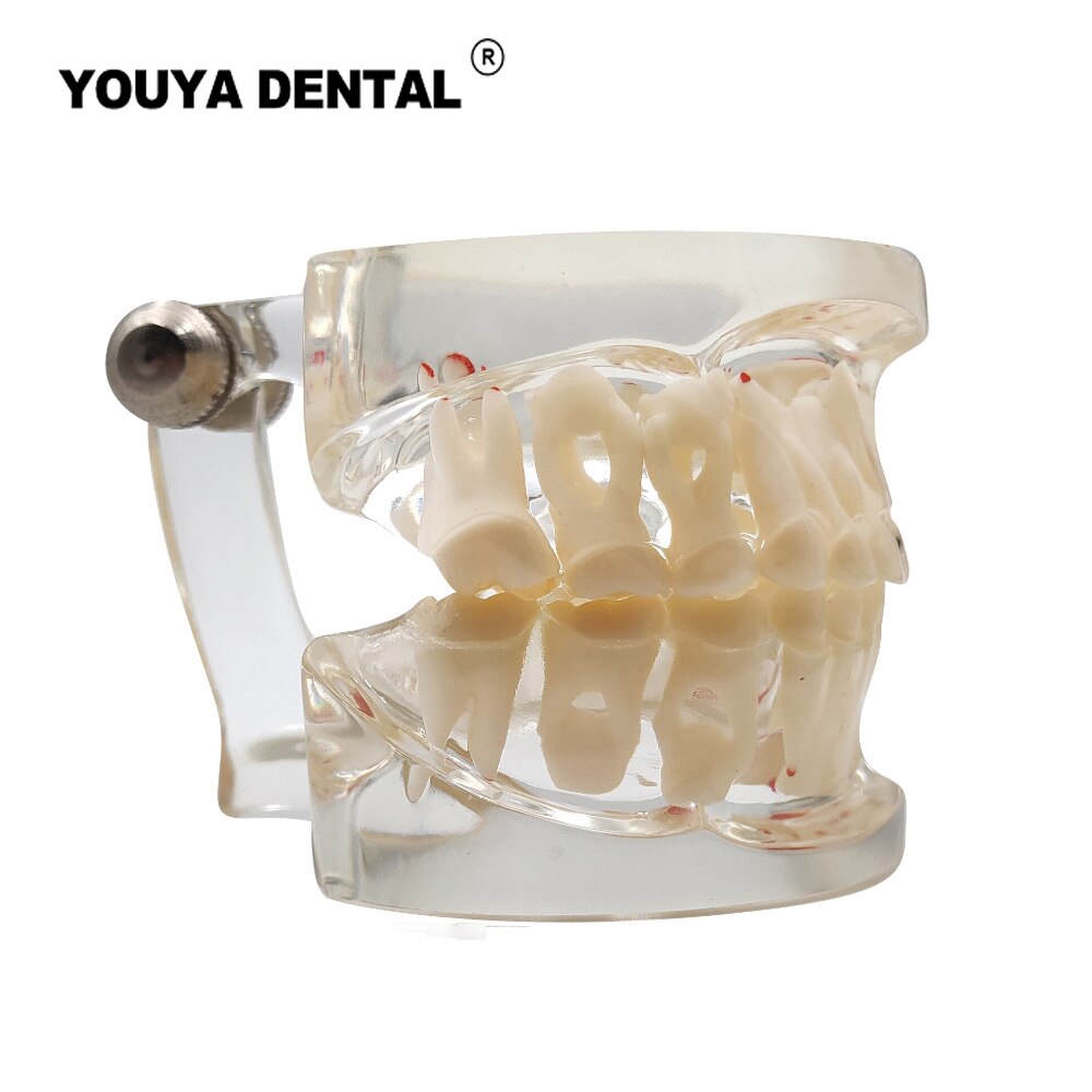 Dental Teaching Model Children Deciduous Tooth Permanent Teeth Alternating Study Pediatric Dental Pathology Preventive Model: Type 1