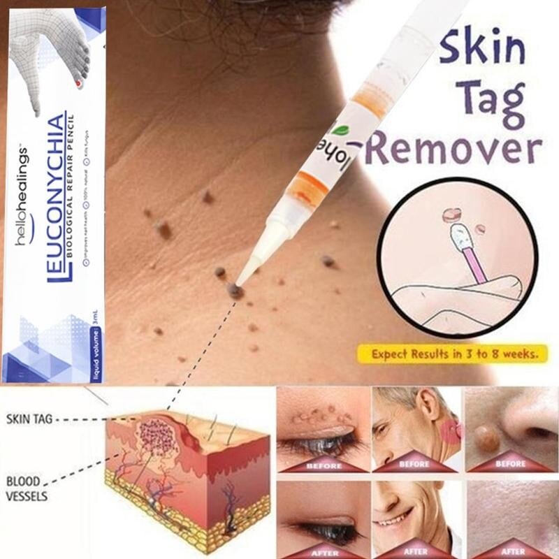 3ml 1pc verruga removedor caneta eficaz pele tag removedor caneta reparação da pele caneta médica matar removedor pé milho etiqueta da pele mole