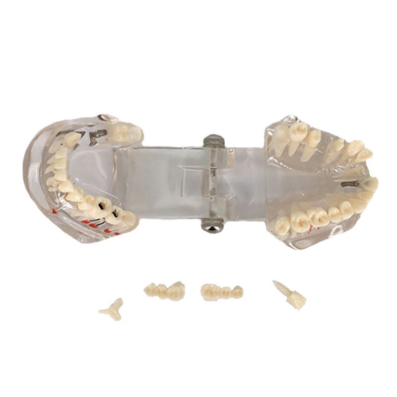 Tandheelkundige Restauratie Tanden Model Transparante Implant Disedental Implant Ziekte Tanden Model Met Restauratie Brug Tand Tandarts