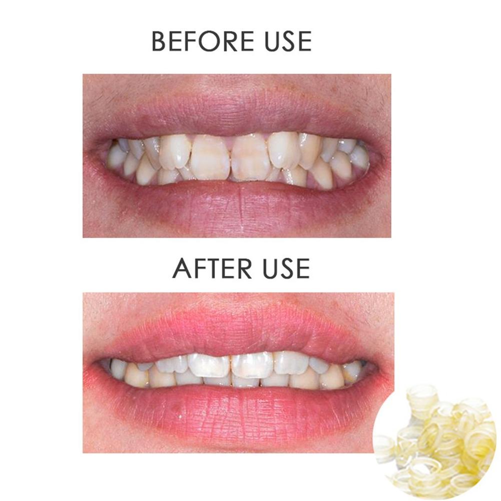 100pcs Dental Materials Disposable Rubber Ring 6.35mm Ligation Ring