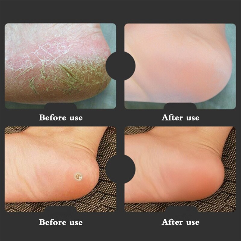 1 Paar Fasciitis Voetverzorging Bescherming Tool Volledige Lengte Siliconen Gel Sokken Gebarsten Plantaris Ademend Yoga Voet Sok