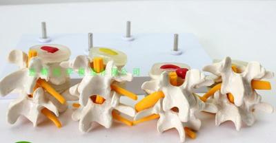 4-Stage Lendenwervel (Ziekte) Variant Model Skelet (Ziekte) theorie Model Skelet/Vervormd Wervelkolom Wervelkolom Onderwijs Levert