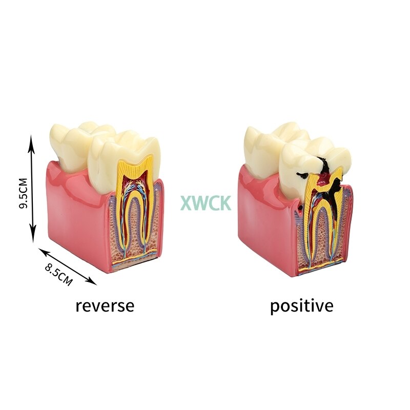 1Pcs 6 Times Dental Caries Comparsion Models Tooth... – Vicedeal