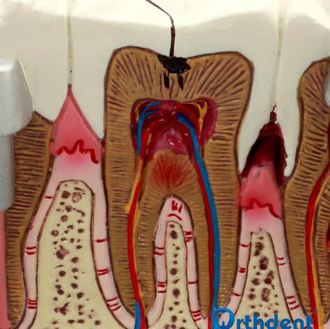 Dental Model Dental Pathology Model Vicedeal