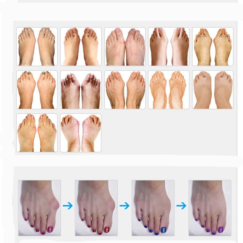 Correcteur d'hallux Valgus en Silicone, 2 paires, correcteur d'oignon du pouce, orthèses de pédicure, séparateurs d'anneaux d'orteils, protection des pieds
