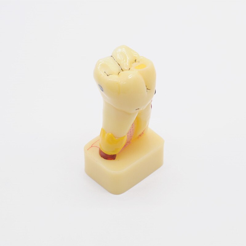 1pc Teeth Model 4 Times Tooth Pathology Model Comprehensive Periodontal Models for Dental Teaching Study Model