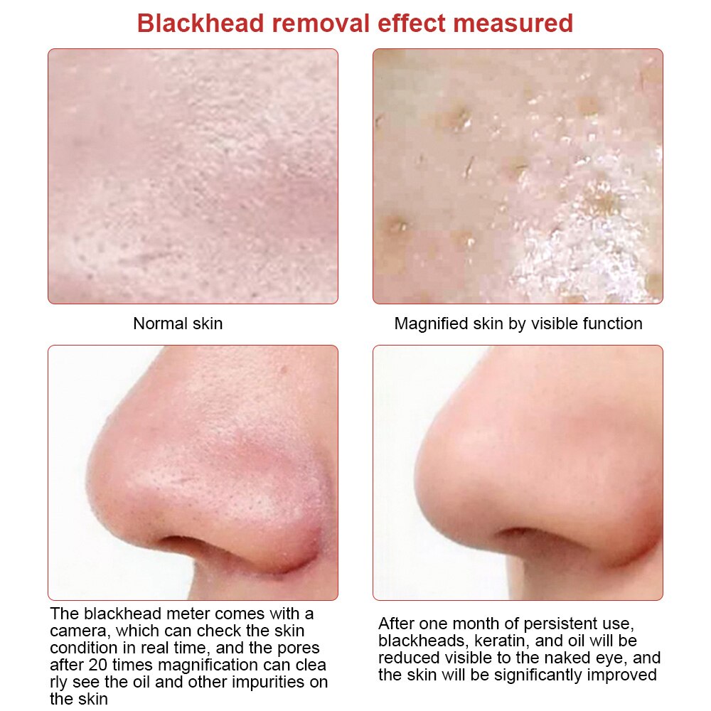 Visible Camera Blackhead Remover for D**a