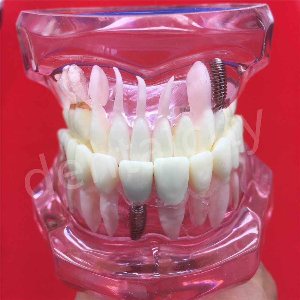 Dental Implant Disease Teeth Model With Restoratio... – Grandado