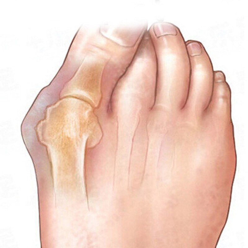 4 stk= 2 par silikone pedicure værktøj hallux valgus korrektur separator glattejern gel tå separator separador fodpleje