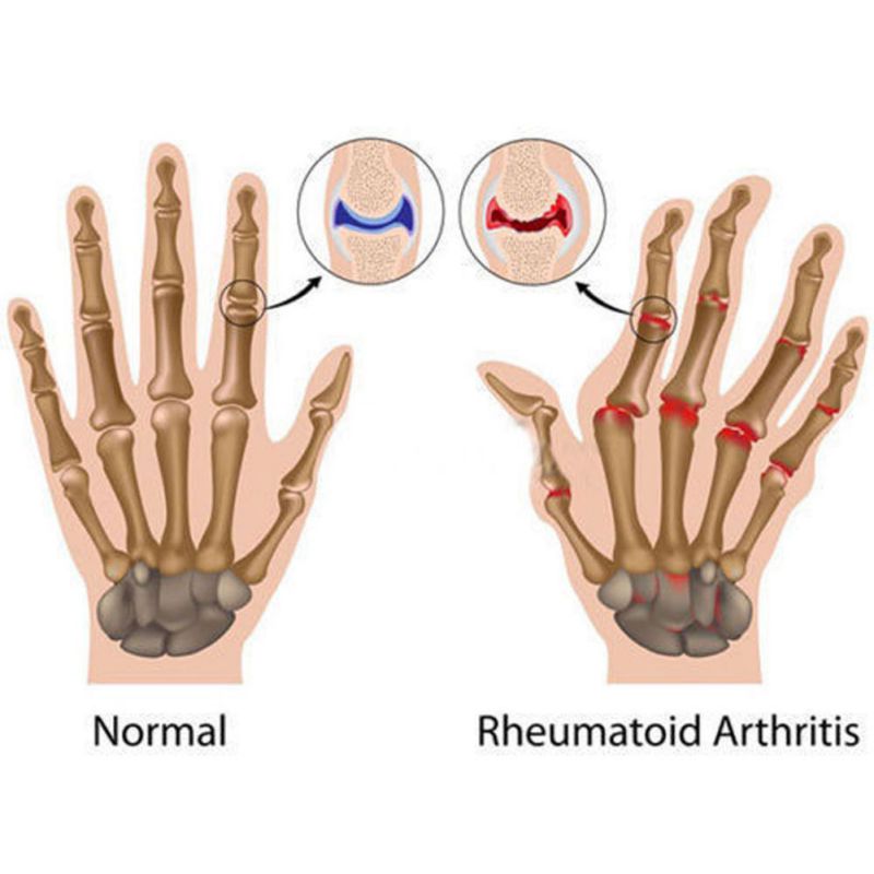 1 Paar Koperen Handen Artritis Handschoenen Therapeutische Compressie Handschoenen Mannen Vrouw Circulatie Grip Artritis Handschoenen