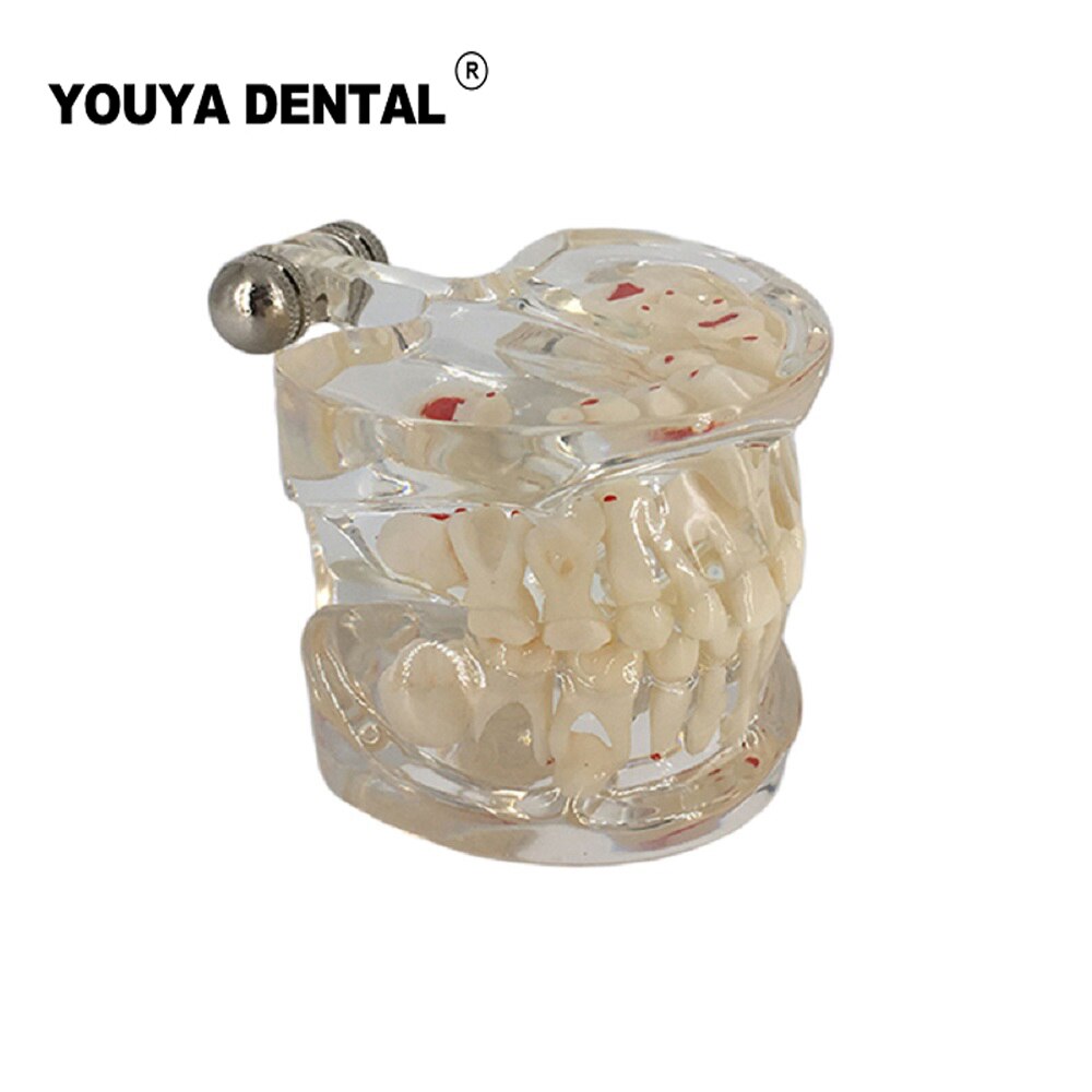 Dental Teaching Model Children Deciduous Tooth Permanent Teeth Alternating Study Pediatric Dental Pathology Preventive Model: Type 4
