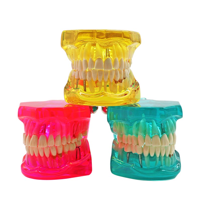 Modèle de dent multicolore, 1 pièce, modèle Standard d&#39;enseignement et d&#39;apprentissage dentaire pour adultes, utilisé dans les cliniques de stomatologie et de recherche