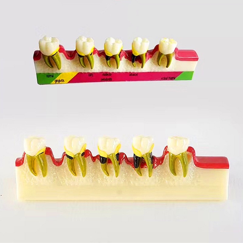 Modello dentale ortodontico con staffa Bretelle Typodont Modello di denti 1:1 Modello di trattamento ortodontico Modello di mascella Typondont  66