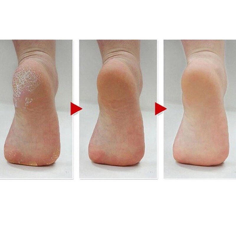 Asun fodplejeværktøj callusfjerner til at fjerne død hud og hård hud på fødderne vaskbar genopladelig