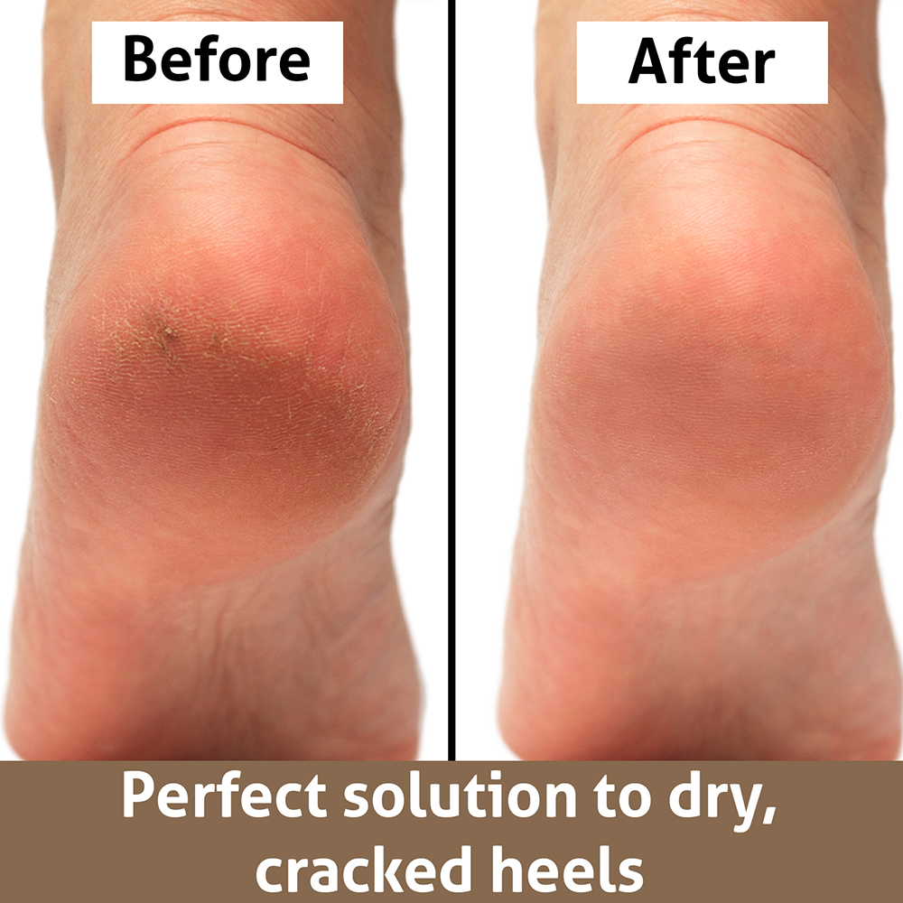 Foot File Callus Remover Tools for Dead Dry Skin Removal Salon Home Pedicure Tool Feet Rasp Callus Remover Heels Grater Scraper