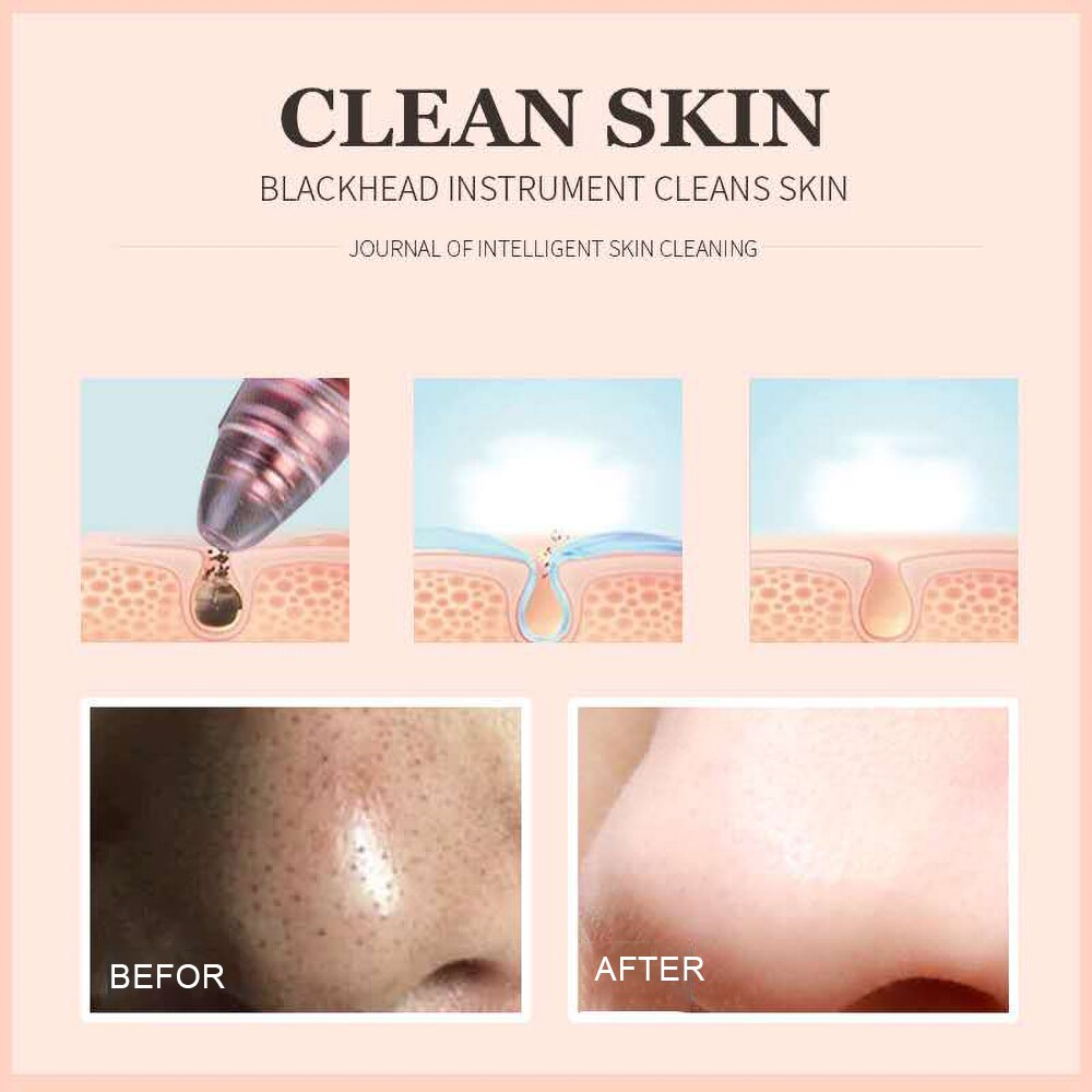 Vacuum Pore Cleaner Face Cleaning Blackhead Remover Tool Blackhead Pore Acne Removal Facial Cleansing Machine Skin Care Device#1