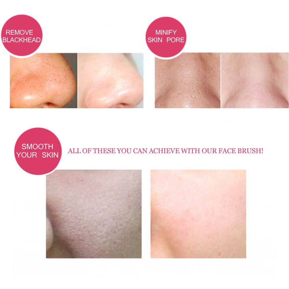 2Pcs Acne Remover Blackhead Tool Stainless Steel Facial Pimple Blackhead Blemish Kit Facial Cleaning Helper Double-ended