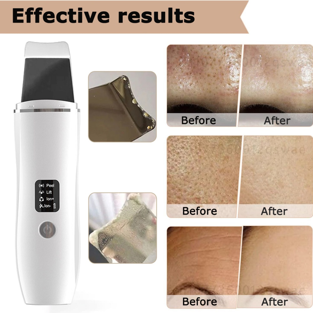 Ultrasonic Skin Scrubber Face Spatula Blackhead Remover for Deep Cleansing Skin Spatula Facial Pore Extractor Peeling Shovel